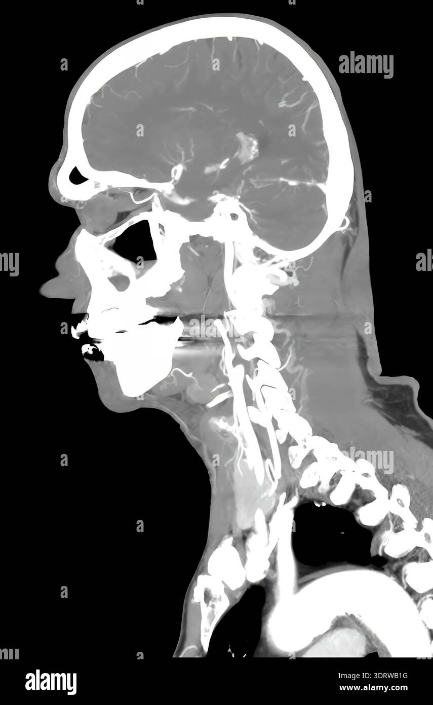 Human head CT scan showing brain and vascular system of a 72 year old ...