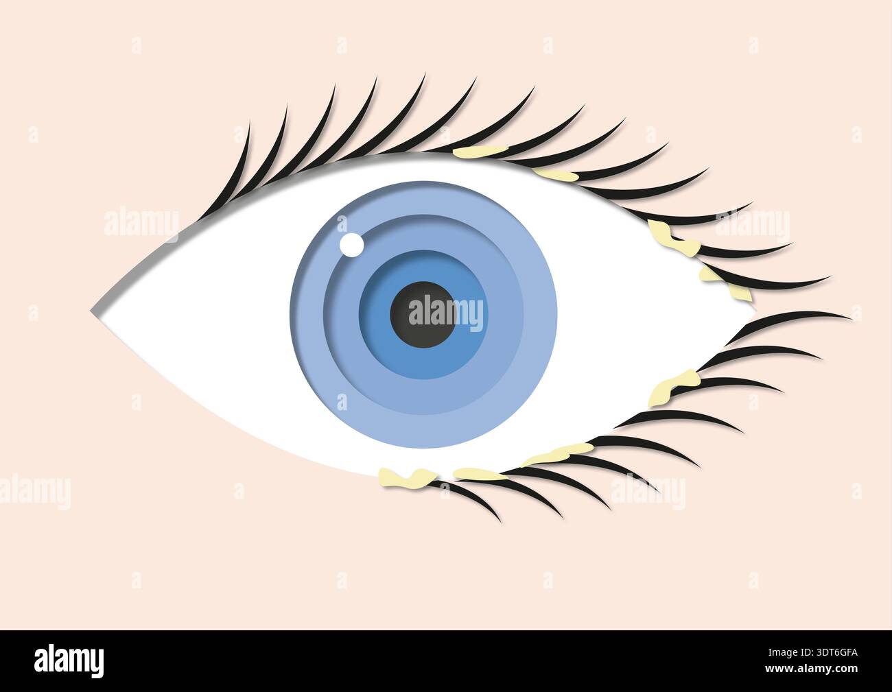 Illustration of blepharitis. This is a chronic inflammation of the ...