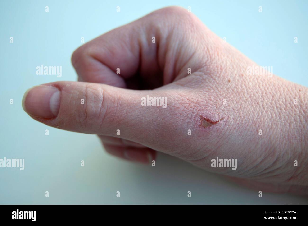Finger scar hi-res stock photography and images - Alamy