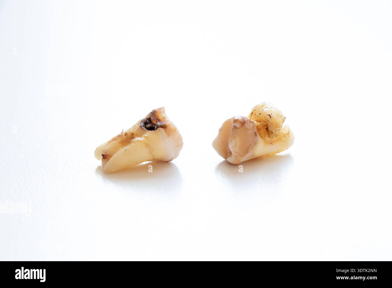 Removed wisdom teeth with decay lie on a white surface for the topics ...
