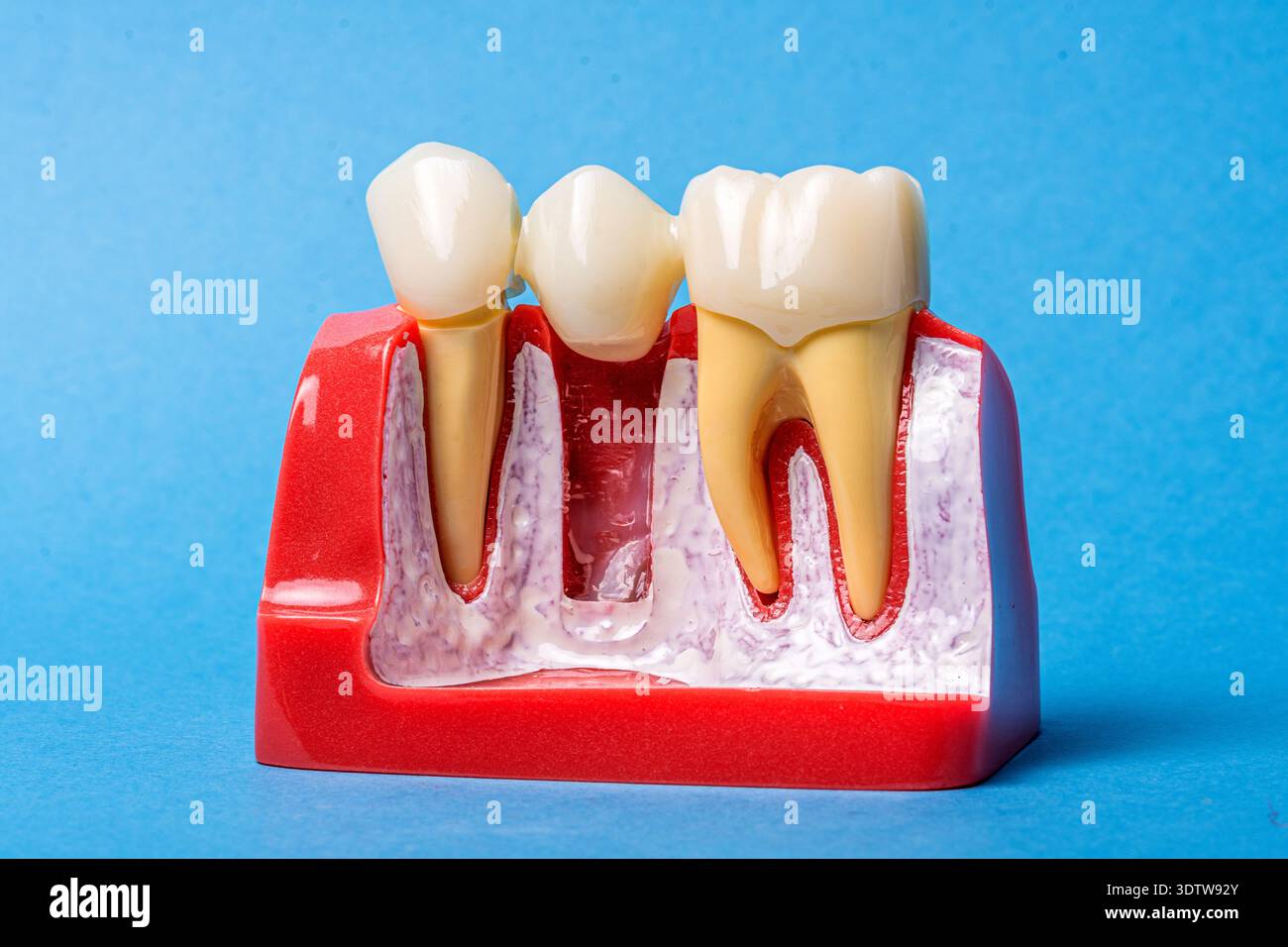 Dental implant and bridge model showing tooth anatomical structure ...