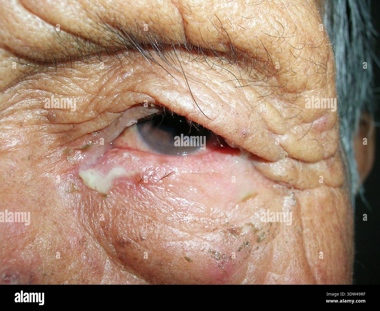 Purulent discharge from the eye of a patient with bacterial conjunctivitis. Conjunctivitis is inflammation of the conjunctiva, the membrane covering the white of the eye. A purulent condition is one where pus is produced, an exudate formed during an infection. Treatment is with antibiotics. Stock Photo