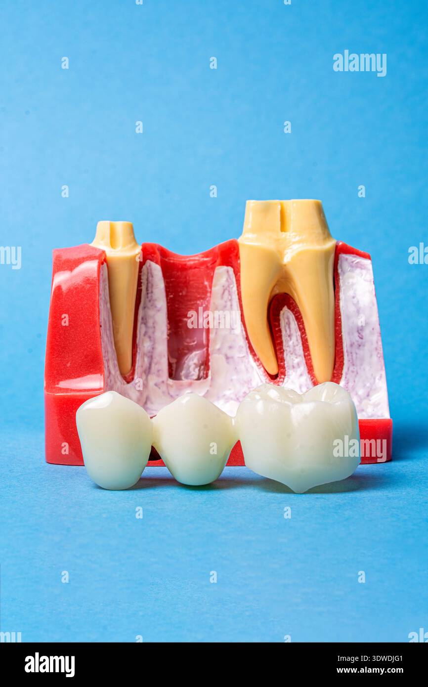 Dental anatomy model showing bridge, crown, and implant procedures ...