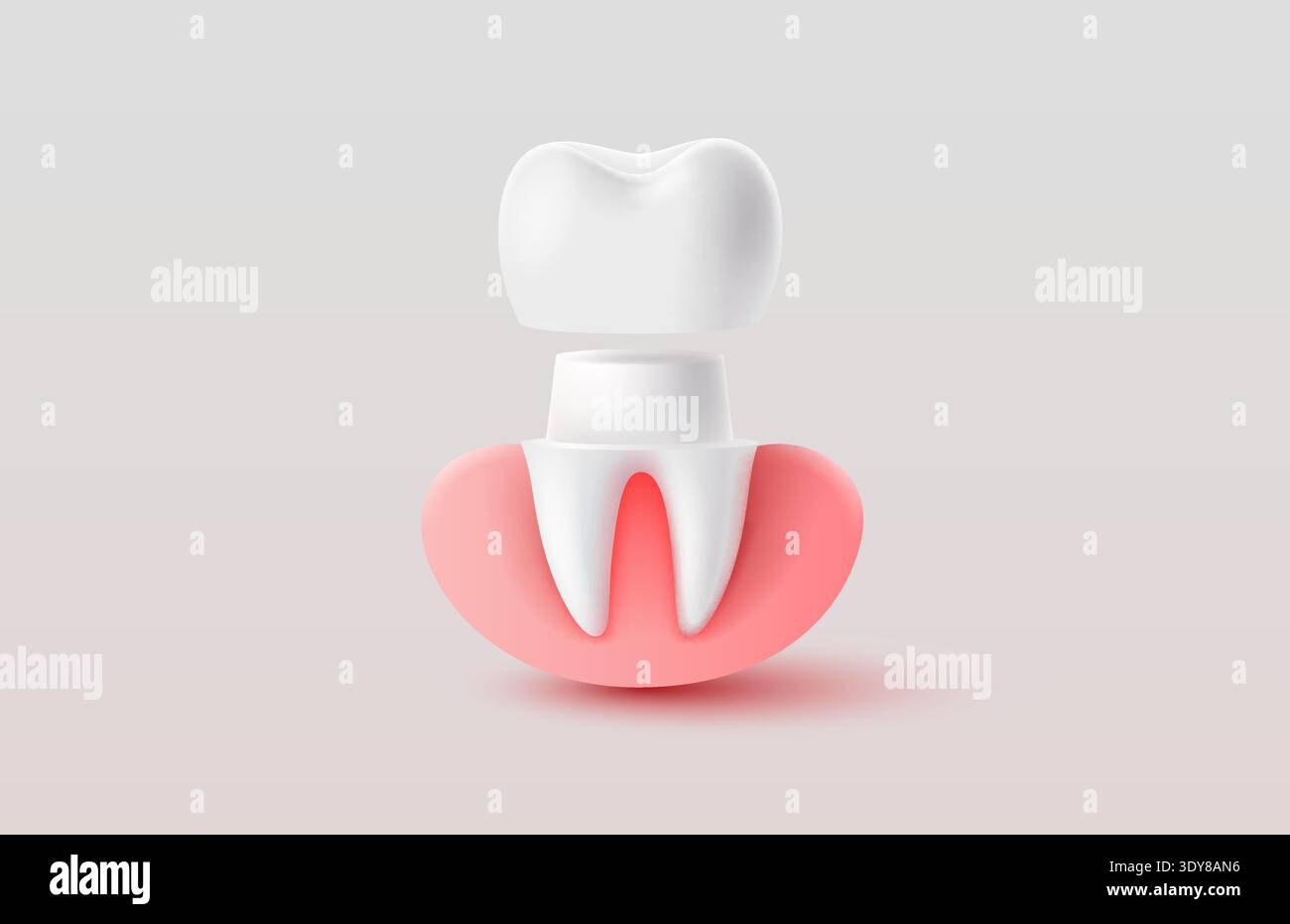 3D dental crown illustration with gum and tooth structure, representing dental health. Vector illustration. Stock Vector