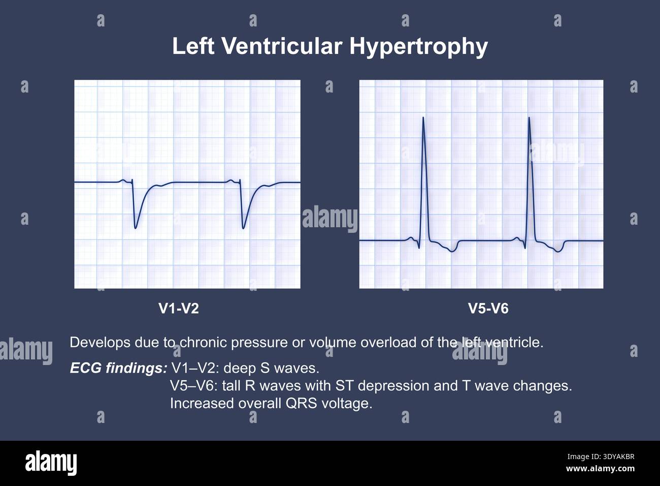 Illustration of an electrocardiogram (ECG) showing left ventricular ...