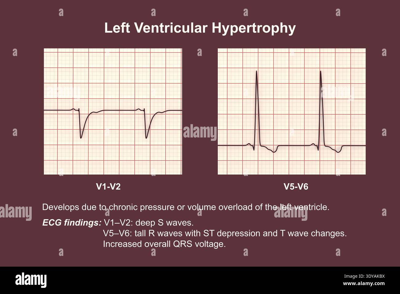 Illustration of an electrocardiogram (ECG) showing left ventricular ...