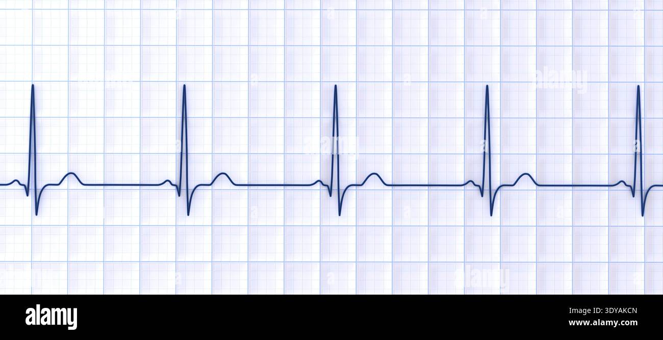 Qrs Normal Rmage Illustration of a normal electrocardiogram (ECG), showing a standard ...