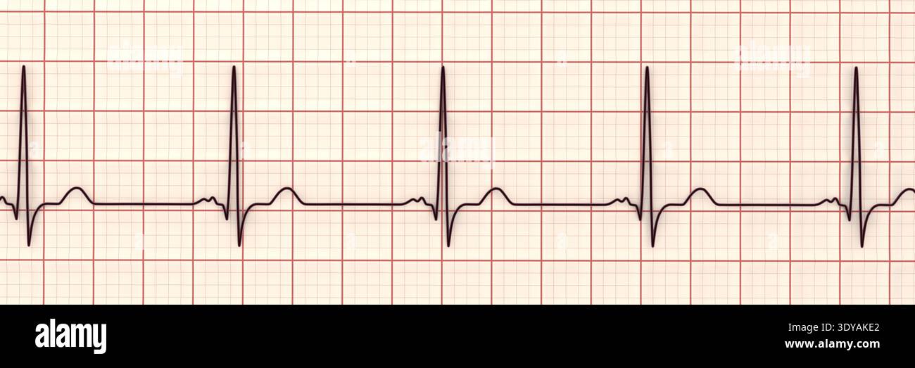 Nothced R Ecg Illustration of electrocardiogram (ECG) with a P-mitrale pattern. It ...