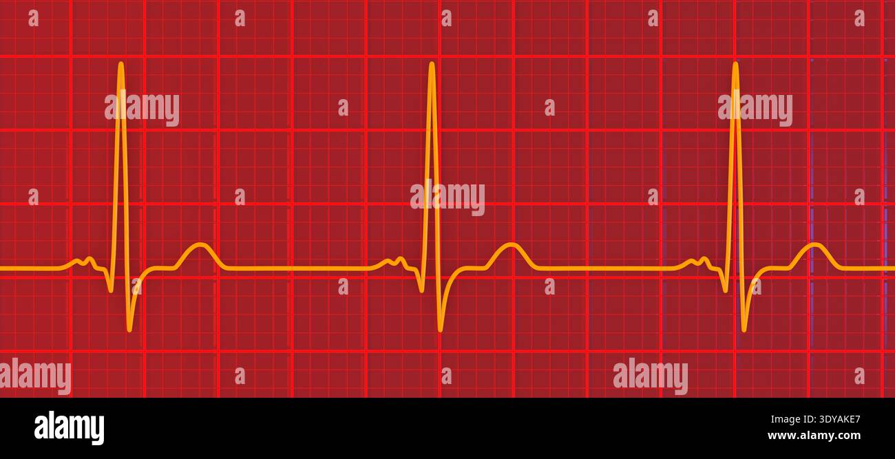 Illustration of electrocardiogram (ECG) with a P-mitrale pattern. It ...