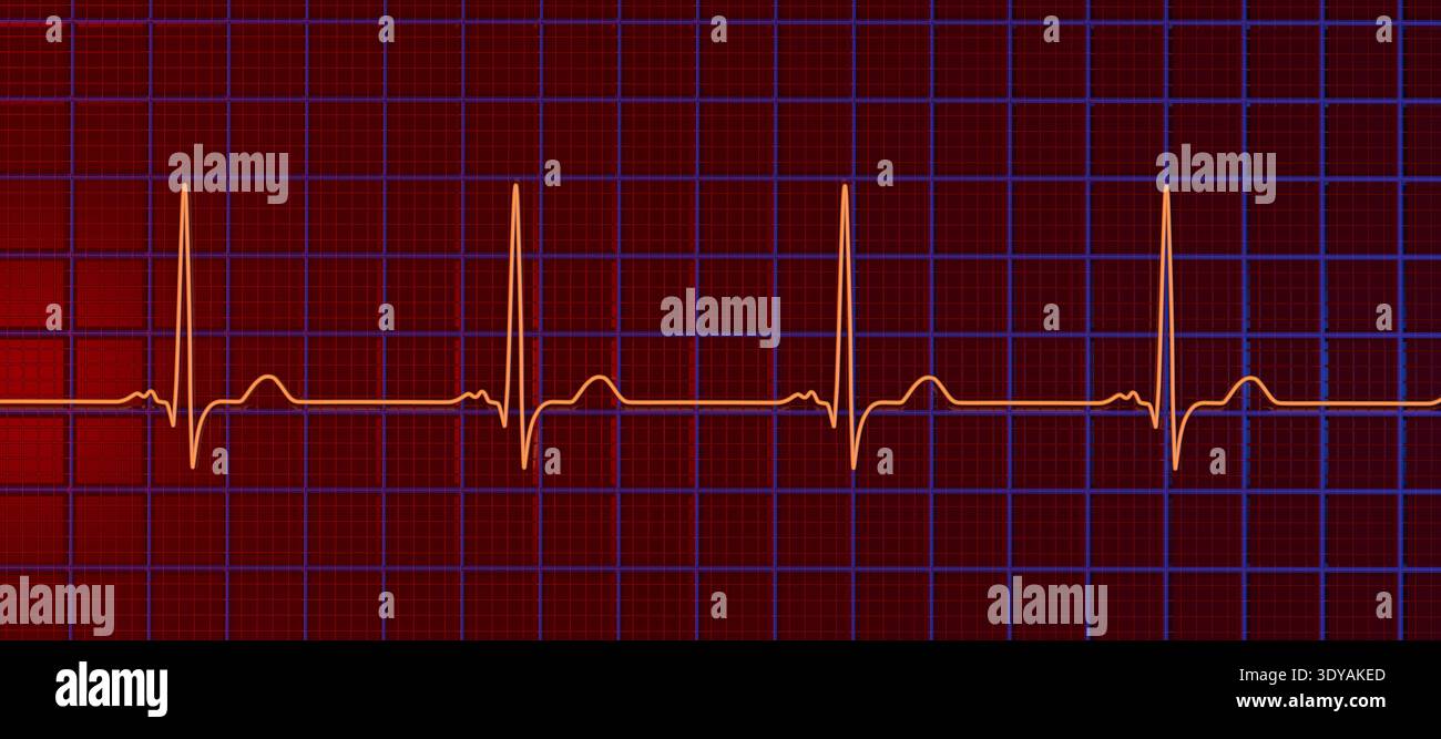 Illustration of electrocardiogram (ECG) with a P-mitrale pattern. It ...