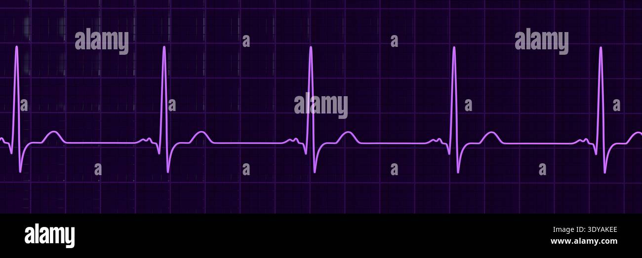 Illustration of electrocardiogram (ECG) with a P-mitrale pattern. It ...