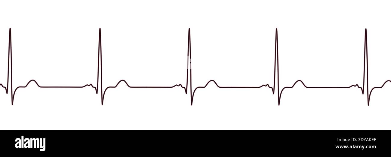 Illustration of electrocardiogram (ECG) with a P-mitrale pattern. It ...