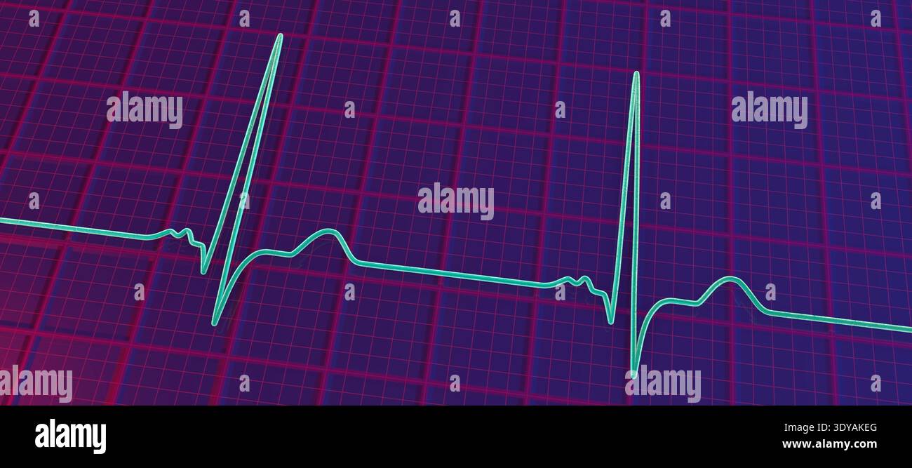 Nothced R Ecg Illustration of electrocardiogram (ECG) with a P-mitrale pattern. It ...