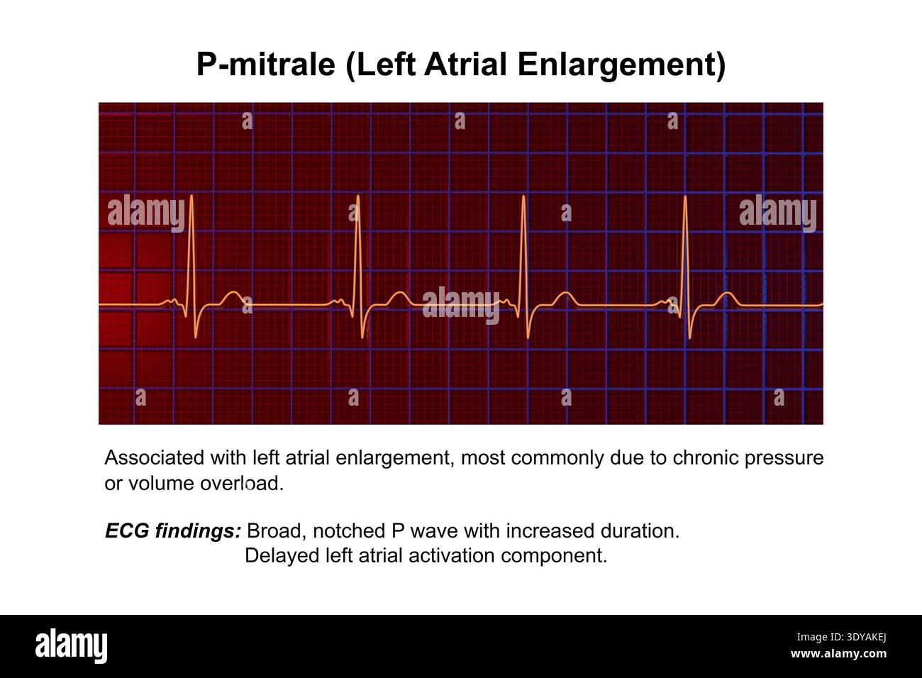 Illustration of electrocardiogram (ECG) with a P-mitrale pattern. It ...