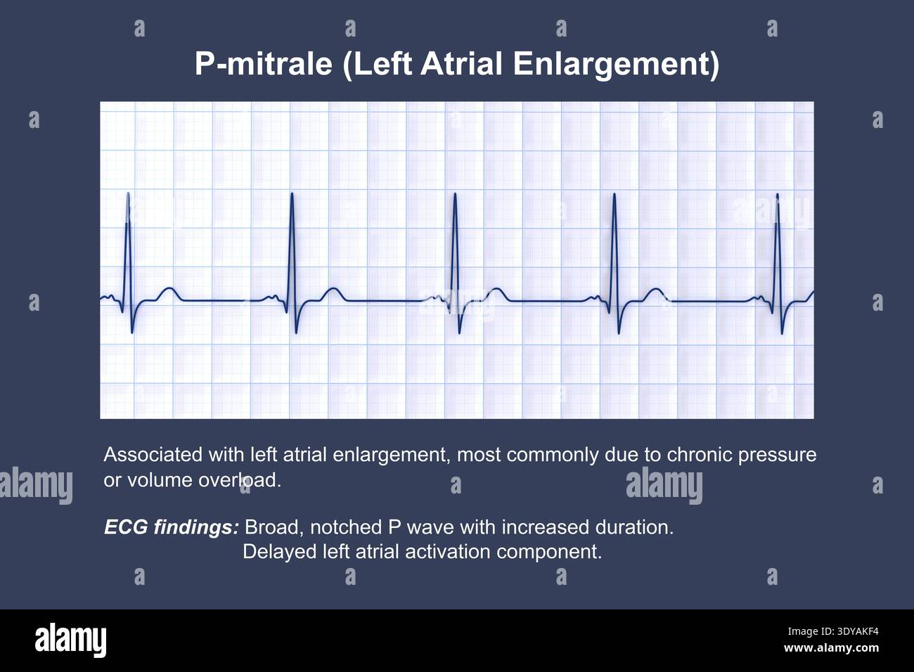 Nothced R Ecg Illustration of electrocardiogram (ECG) with a P-mitrale pattern. It ...