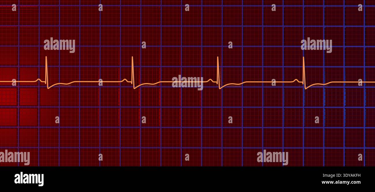 Illustration of an electrocardiogram (ECG) showing right ventricular ...