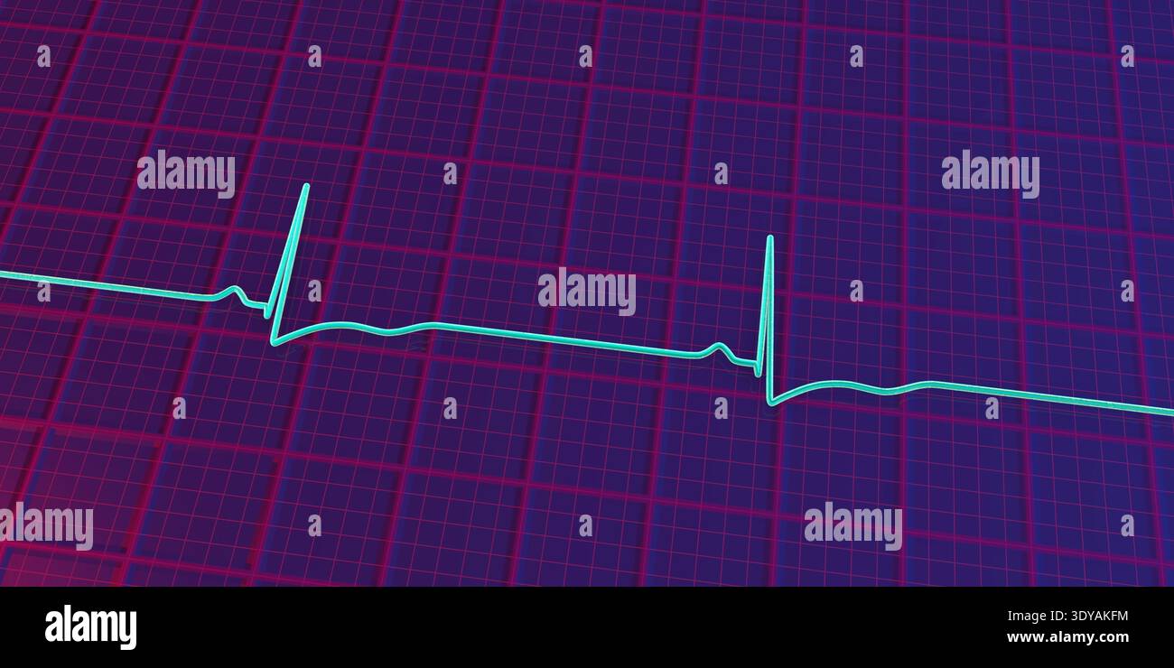 Illustration of an electrocardiogram (ECG) showing right ventricular ...