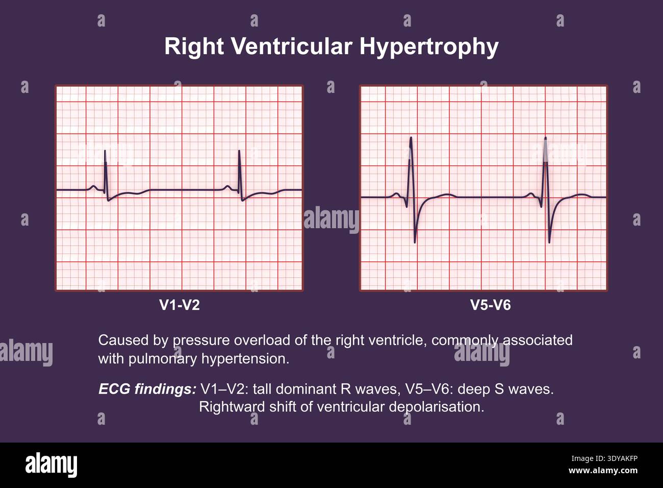 Illustration of an electrocardiogram (ECG) showing right ventricular ...