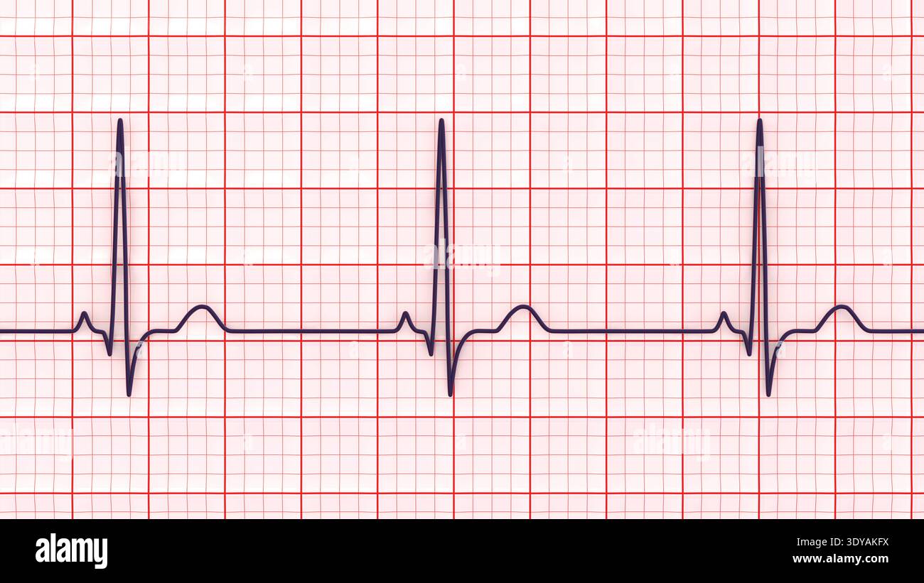 Illustration of electrocardiogram (ECG) with a P-pulmonale pattern. It ...
