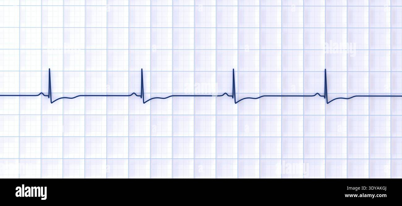 Illustration of an electrocardiogram (ECG) showing right ventricular ...