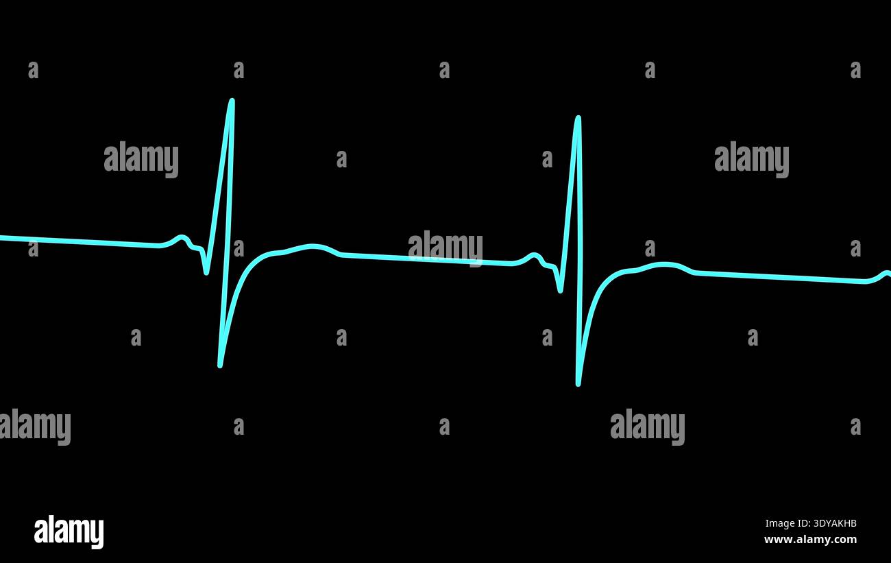 Illustration of an electrocardiogram (ECG) showing right ventricular ...
