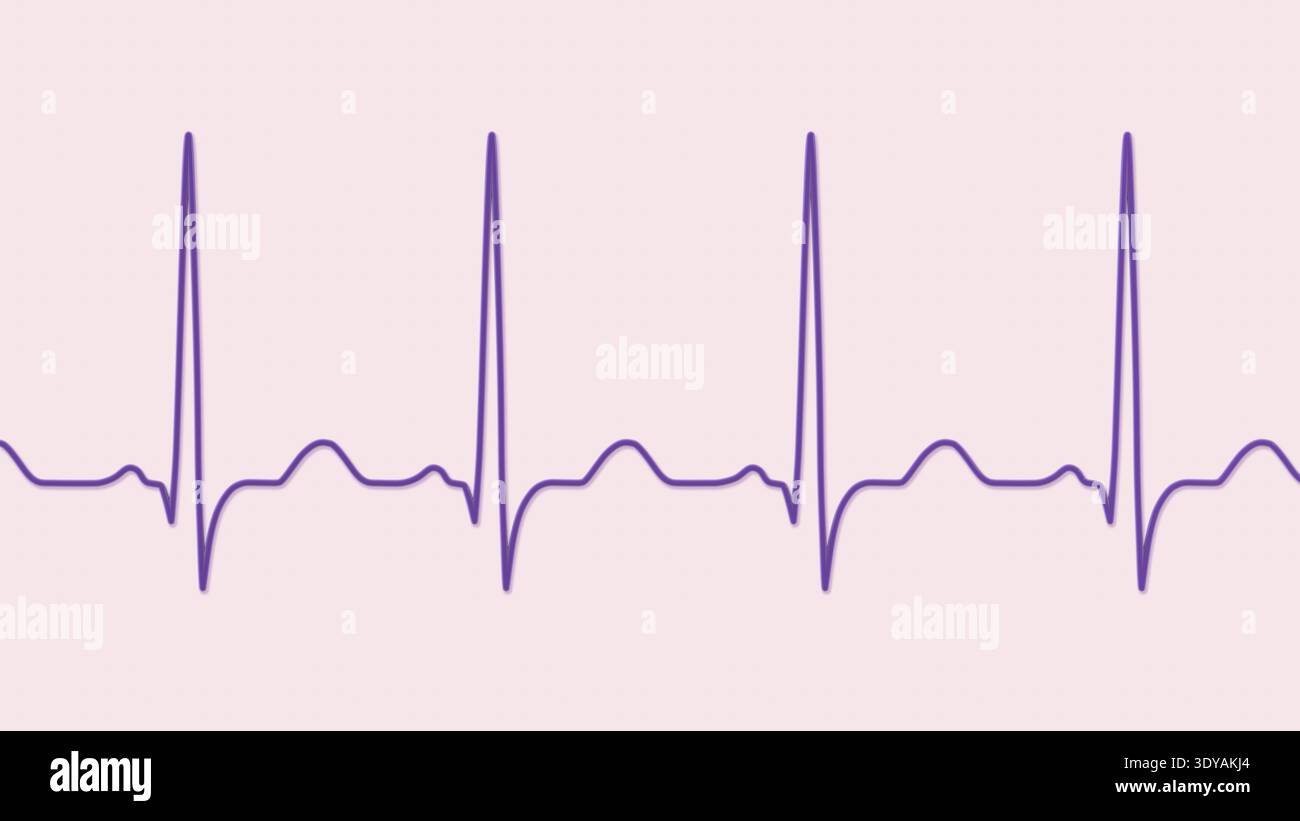 Illustration of an electrocardiogram (ECG) showing sinus tachycardia ...