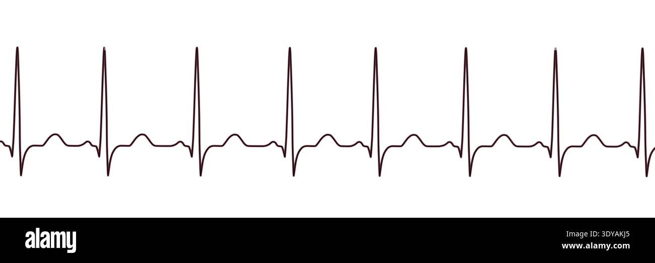 Illustration of an electrocardiogram (ECG) showing sinus tachycardia ...