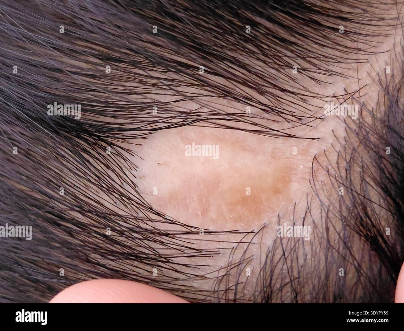 Birth defect hi-res stock photography and images - Alamy