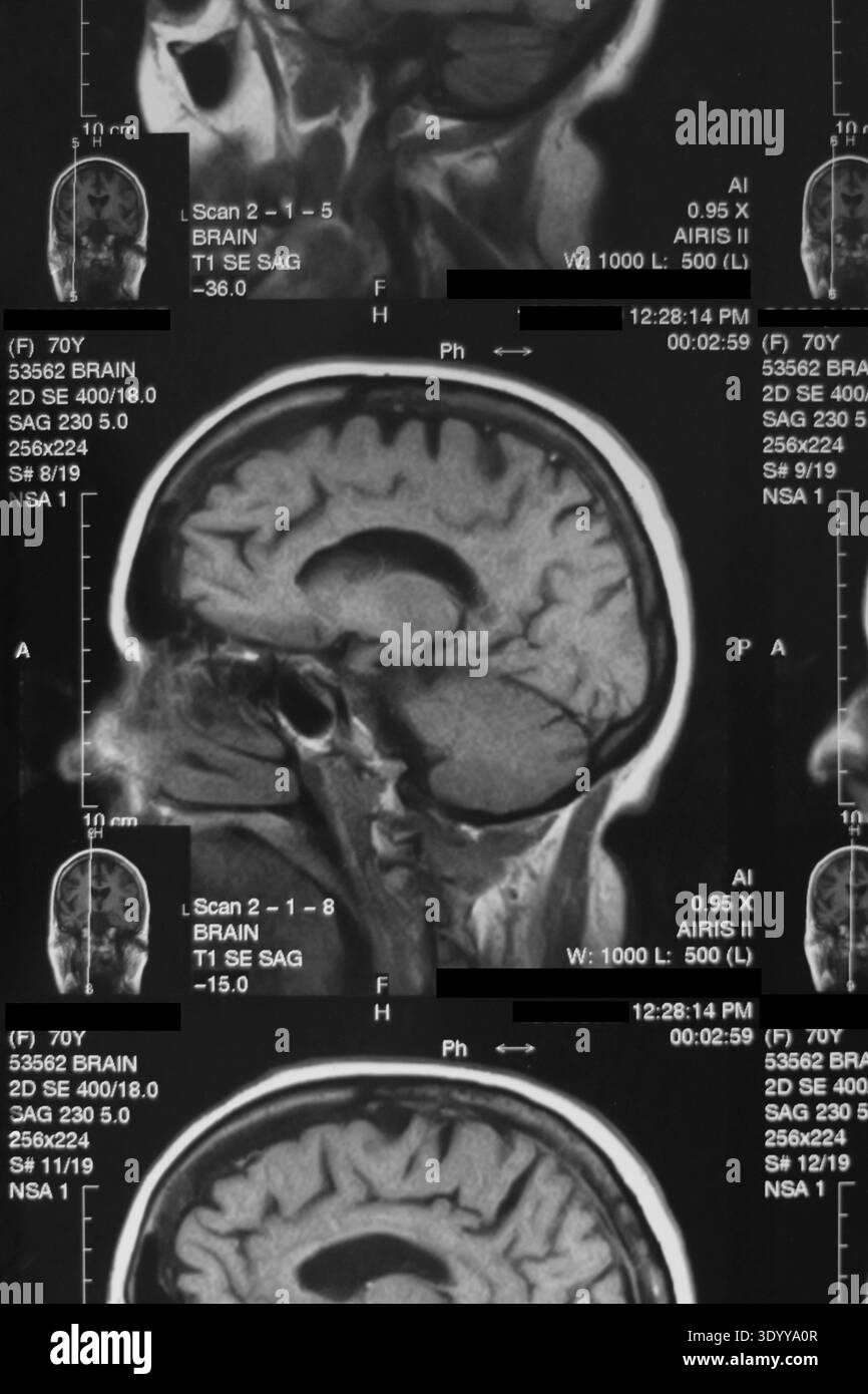 Magnetic Resonance Imaging (MRI) scan of the brain from an Hitachi ...
