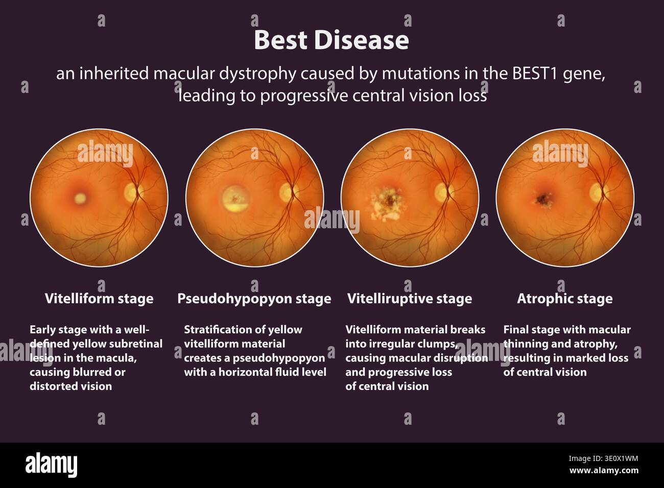 best-disease-stages-2-5-illustration-showing-colour-fundus-views-of