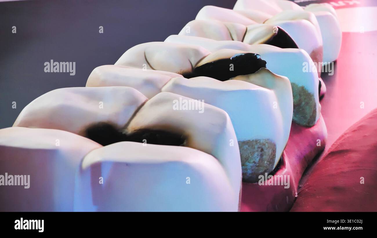 Dental educational model showing tooth decay and advanced caries ...