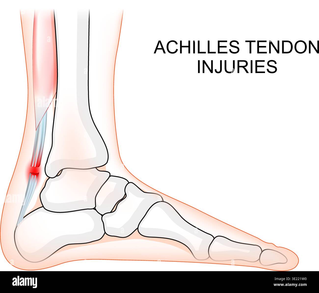 Achilles Tendon Bursitis