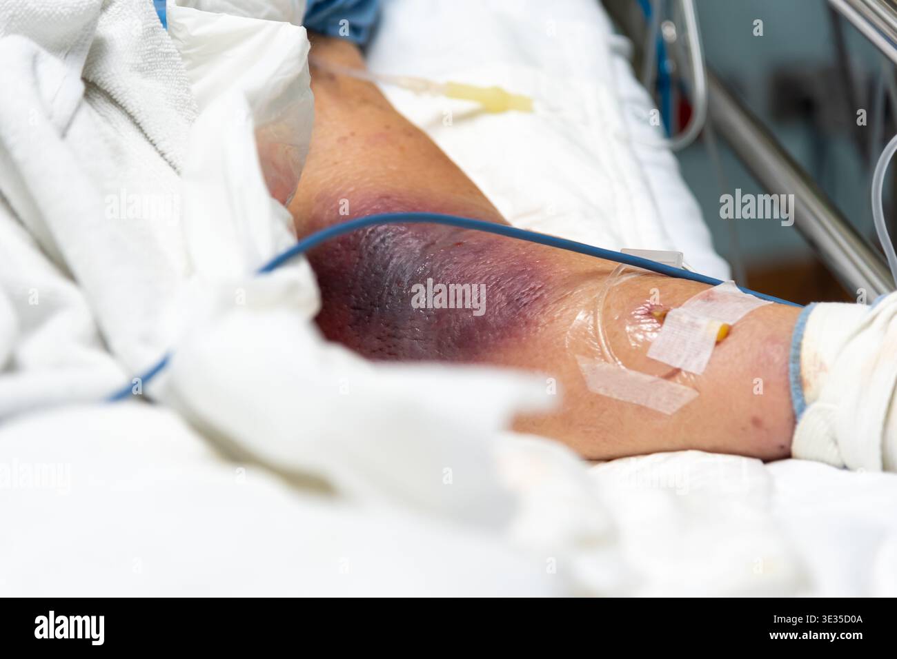 Close up of patient arm with severe bruising and IV line in hospital ...