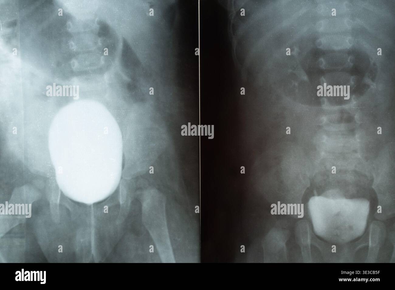 X-ray of a child's pelvis and bladder with contrast for diagnostics ...