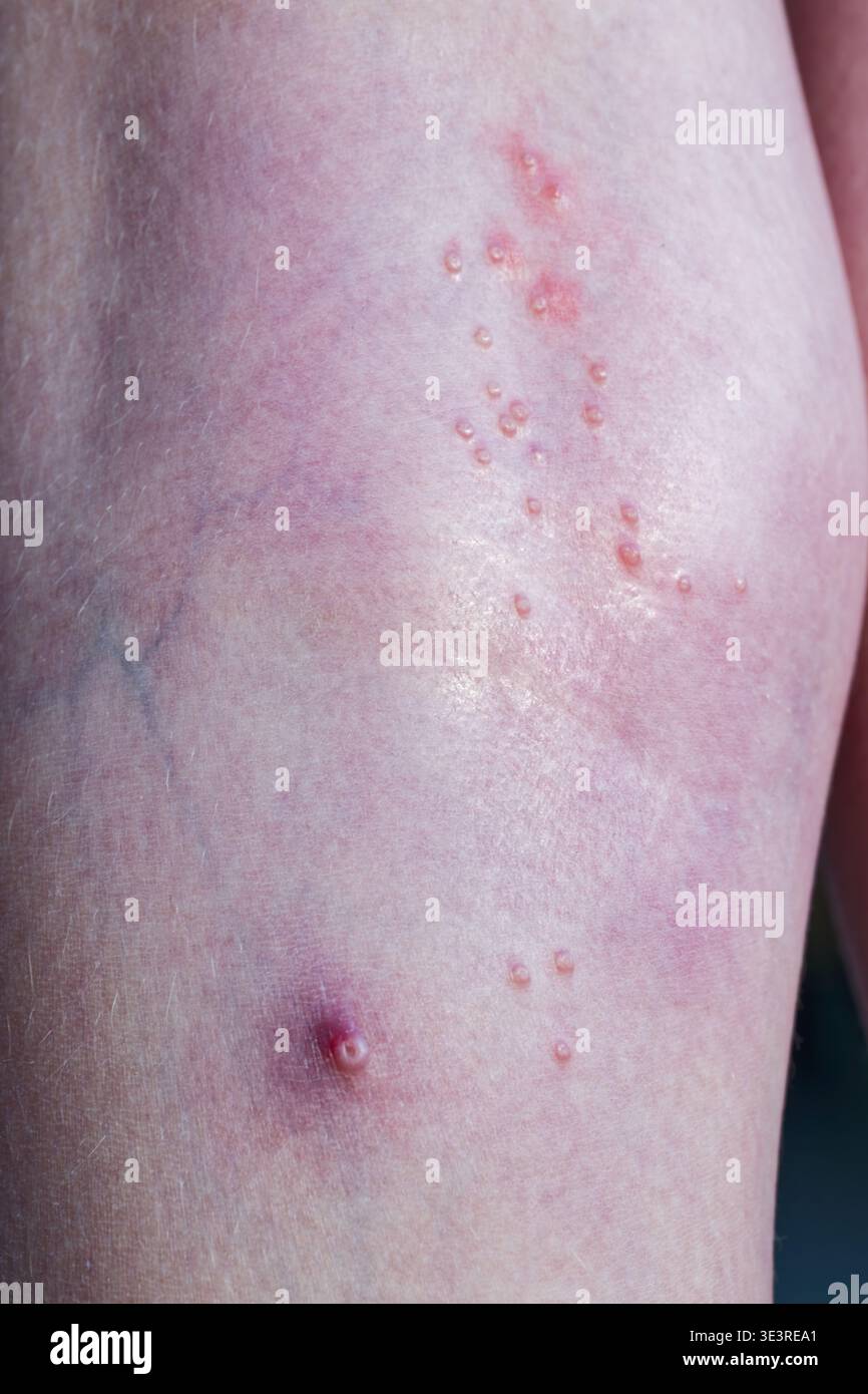 Cluster Rashes Red irritated skin with clusters of small fluid filled blisters and ...
