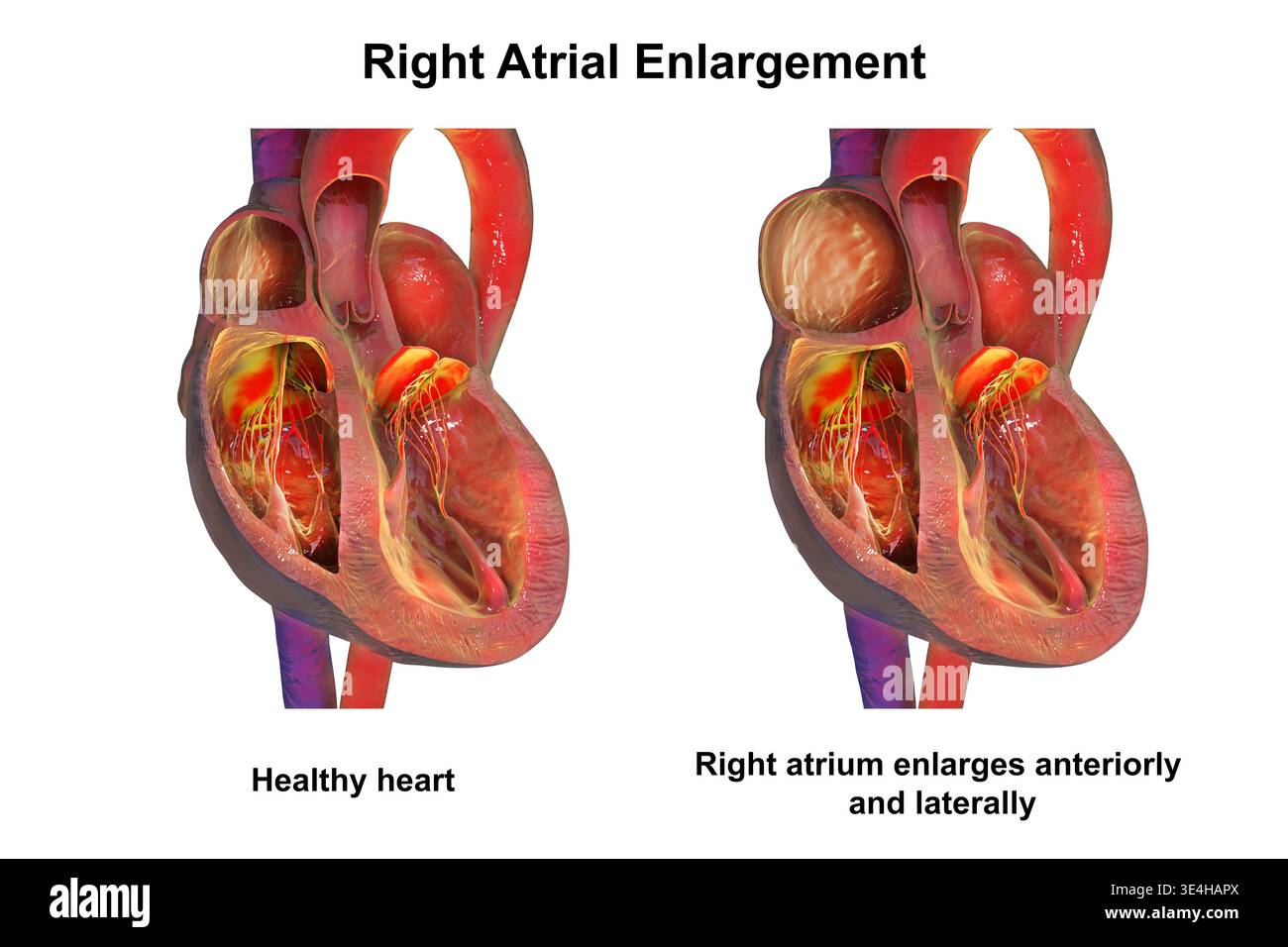 Normal Atrium Area Size Healthy heart and right atrial enlargement. Illustration showing normal ...