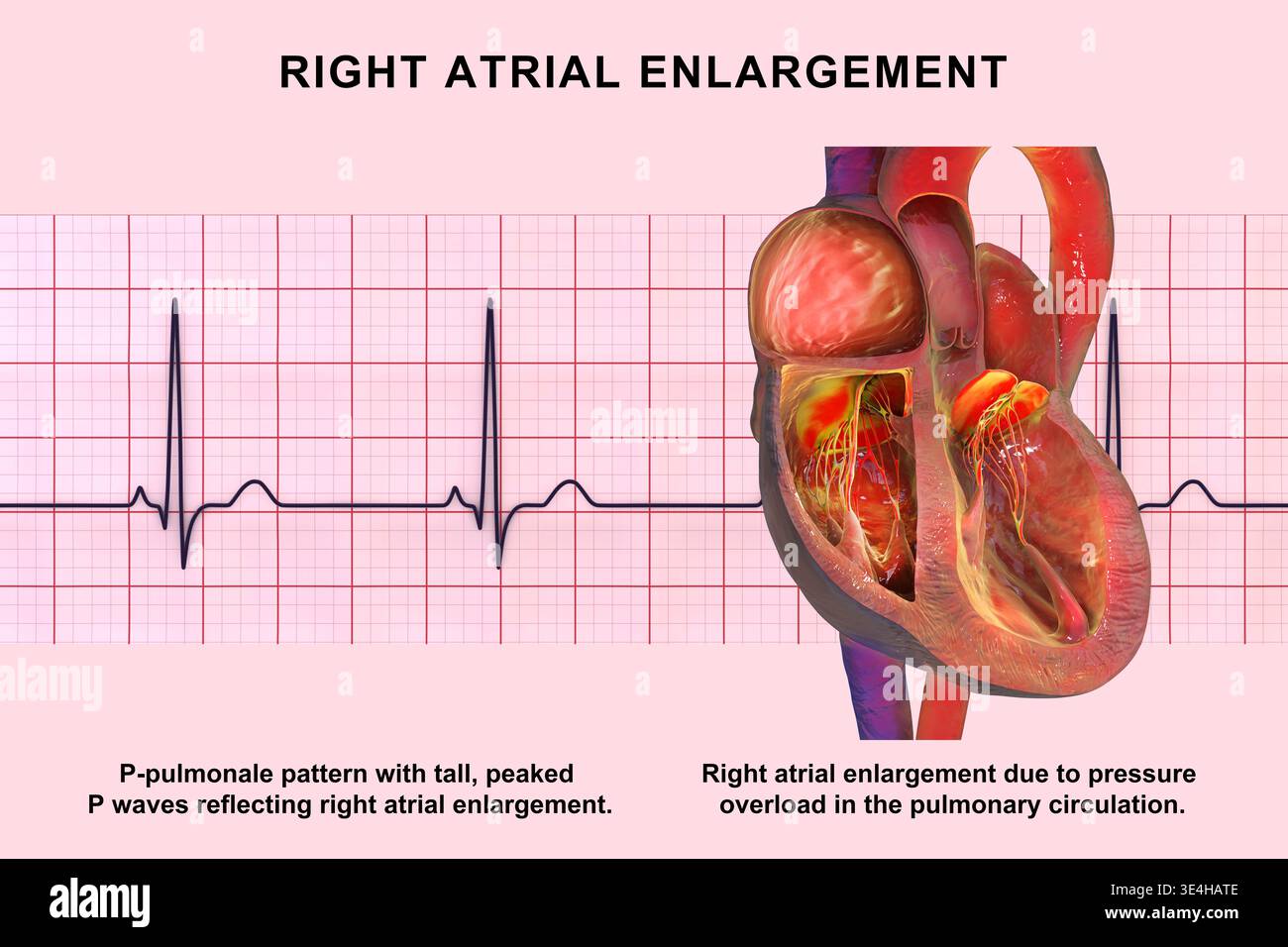Right atrial dilation with P-pulmonale. Illustration showing an ...
