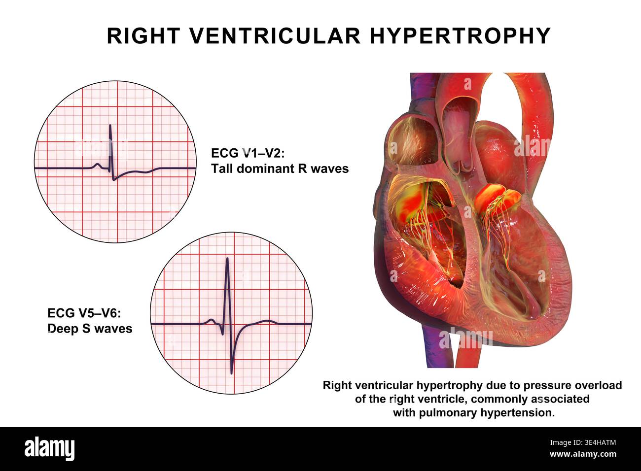 Right ventricular hypertrophy. Illustration showing thickened right ...