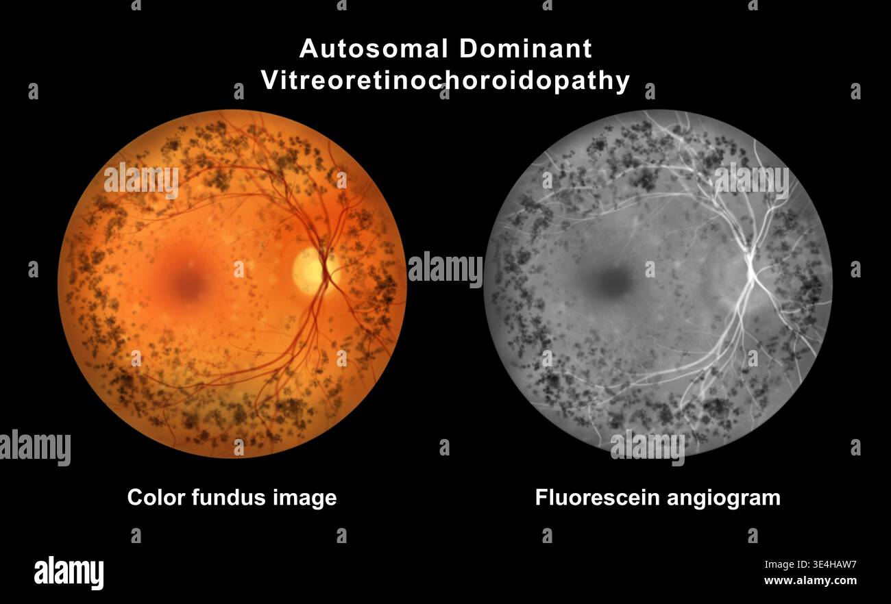 Autosomal dominant vitreoretinochoroidopathy. Illustration showing ...