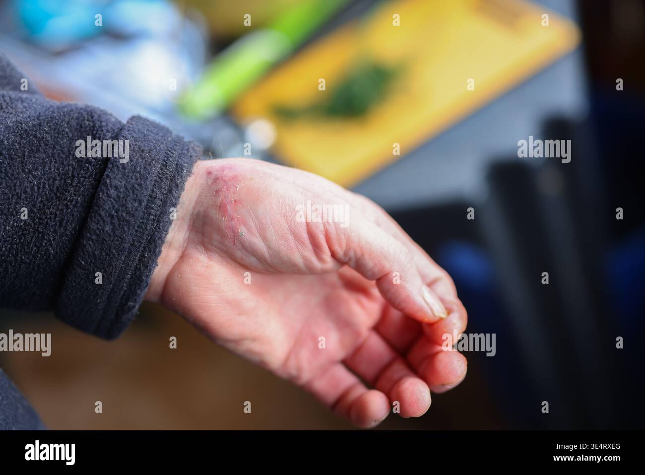 Scar on hand after sutured wound, healing skin and recovery process, medical injury and rehabilitation concept. Stock Photo