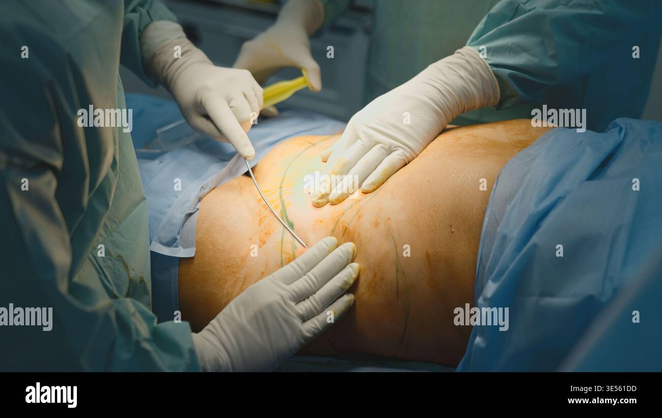 Close up two unrecognizable doctors men surgeons doing delicate belly surgery operation abdominal liposuction physicians males working in medicine Stock Photo