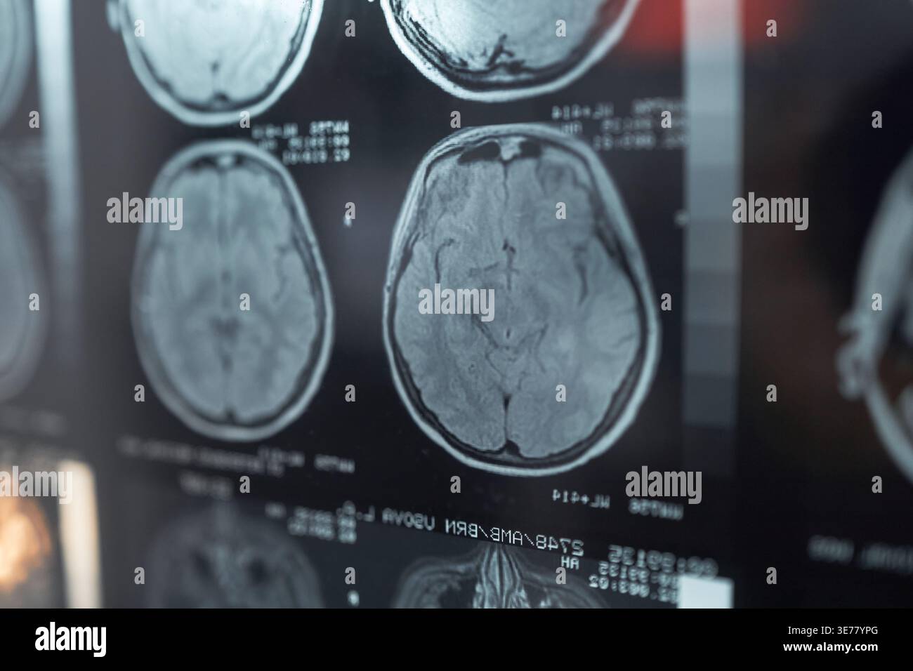 Close up of brain MRI scans displaying diagnostic imaging for ...