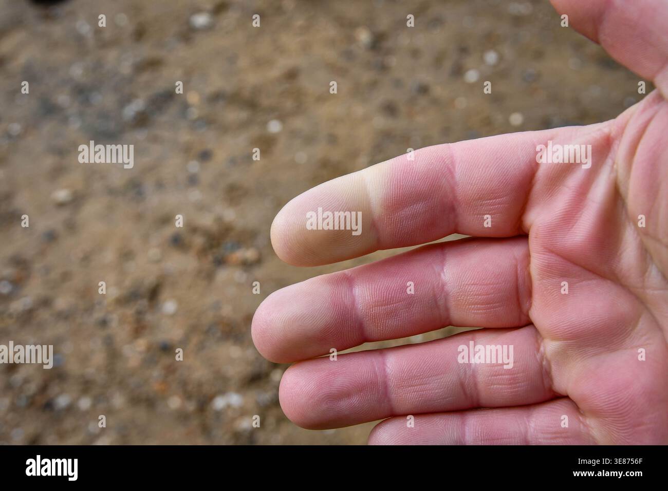 pictures of vibration white finger What is 'White Finger'? | Norton Abrasives main image 1