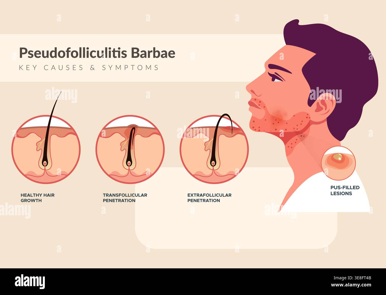 Malassezia folliculitis hi-res stock photography and images - Alamy