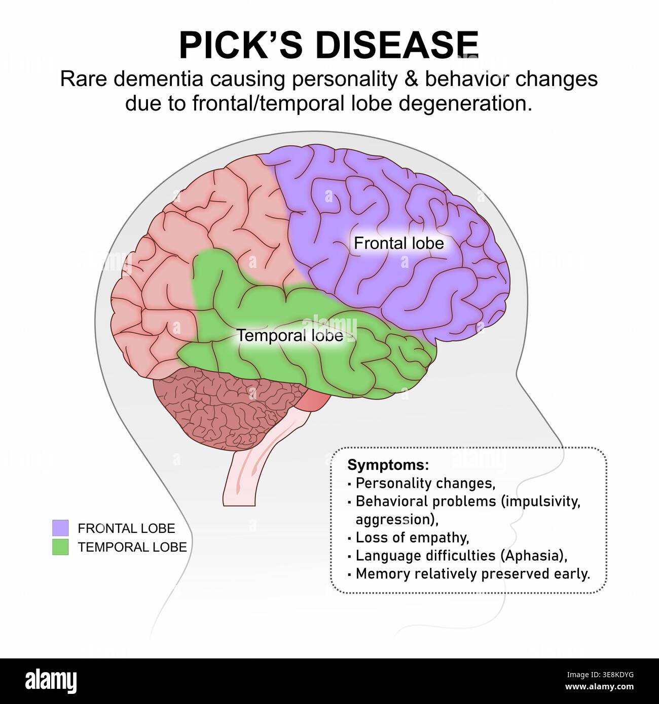 Frontal temporal dementia brain hi-res stock photography and images - Alamy