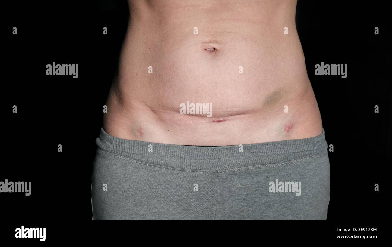 Appendicitis scar hi-res stock photography and images - Alamy