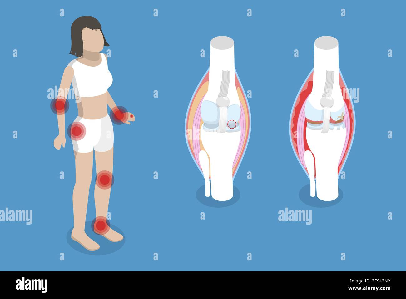 Rheumatoid arthritis x ray hi-res stock photography and images - Alamy