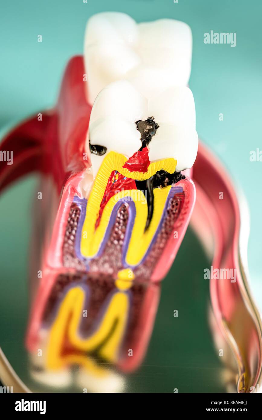 Pulp Caries Zahnanatomiemodell hi-res stock photography and images - Alamy