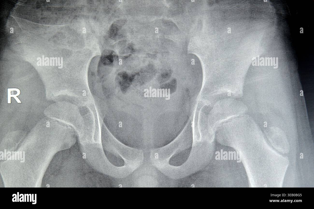 Normal Plate normal pelvic X-ray for an 8-year-old child typically shows an immature ...