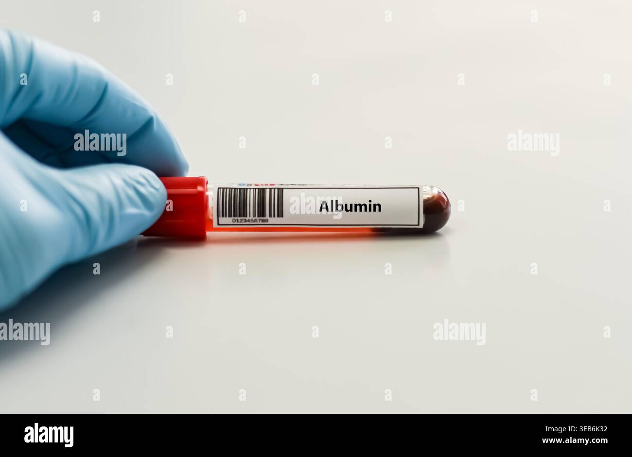 Blood sample tube for albumin test analysis Stock Photo - Alamy